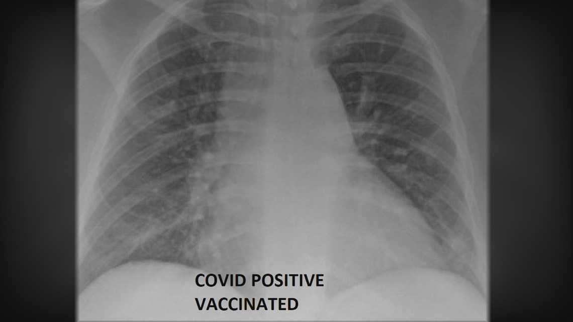 Foto: Pluća covid pozitivne vakcinisane osobe/ KSDK